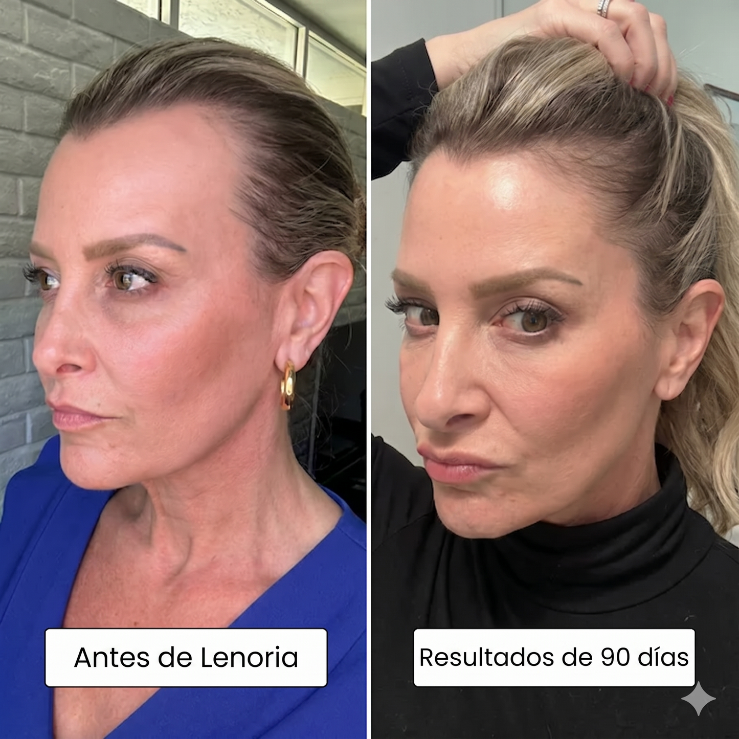 Lenoria ® - Recuperá caida de cabello por hormonas